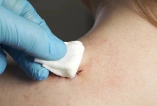 Curso gratuito de Básico em Curativos e Feridas